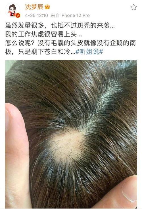 明星有谁治好了脱发,揭秘脱发生长的神奇疗法